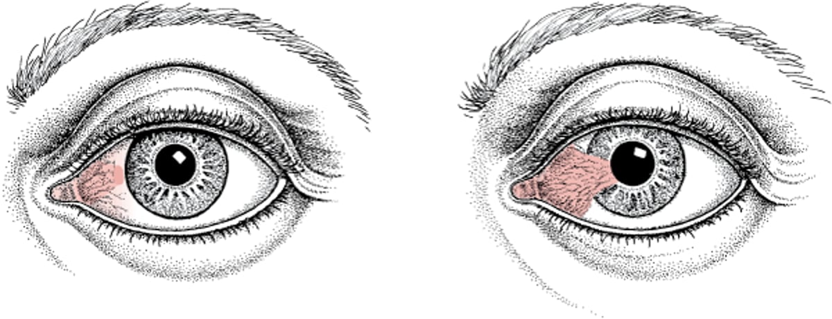 Pinguecula und Pterygium