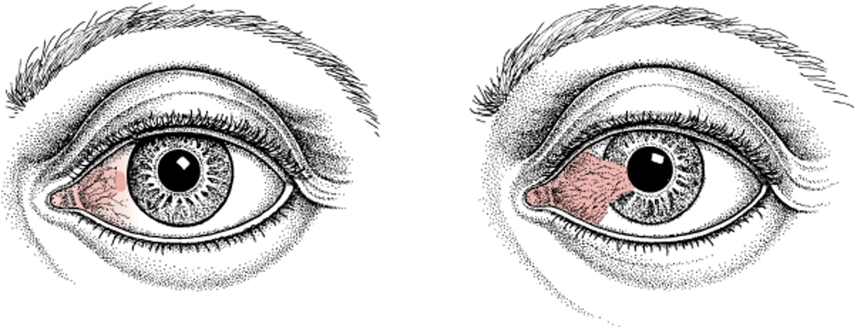 Pinguécula y pterigion