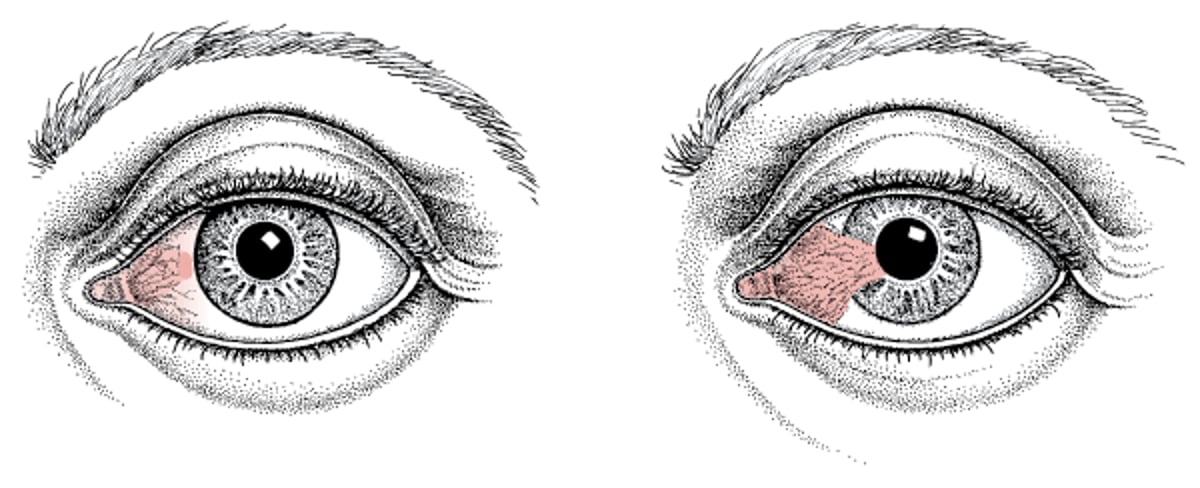 Pinguecula e pterigio