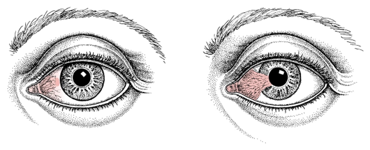 Pinguécula e pterígio