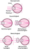 Was ist Lichtbrechung?