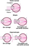 Qué es la refracción