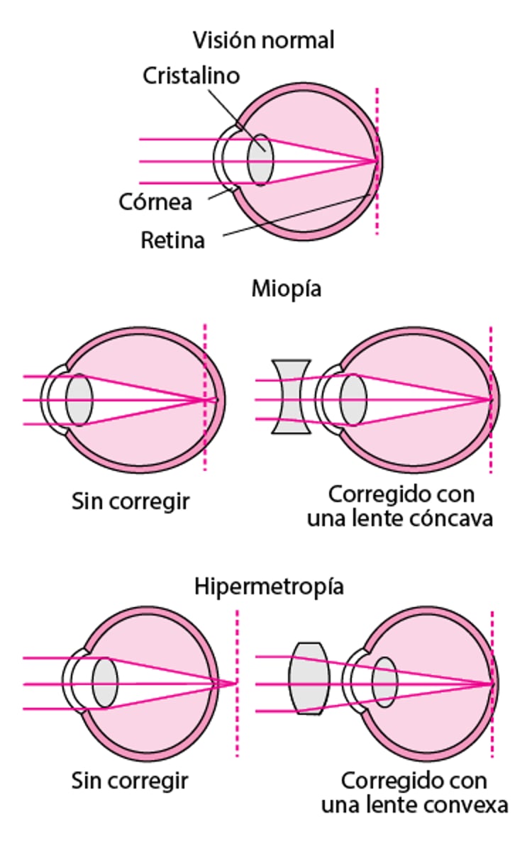 Qué es la refracción