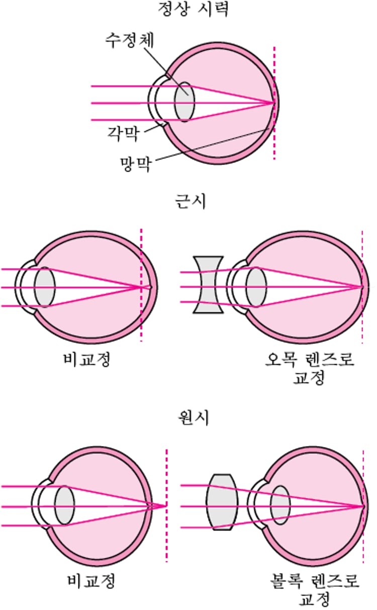 굴절에 대한 이해