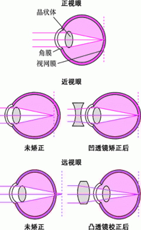 了解屈光