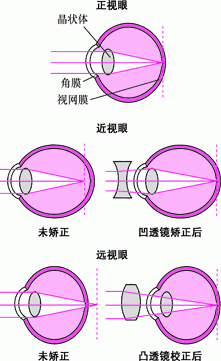 屈光不正概述 - 眼疾 - 《默沙东诊疗手册大众版》