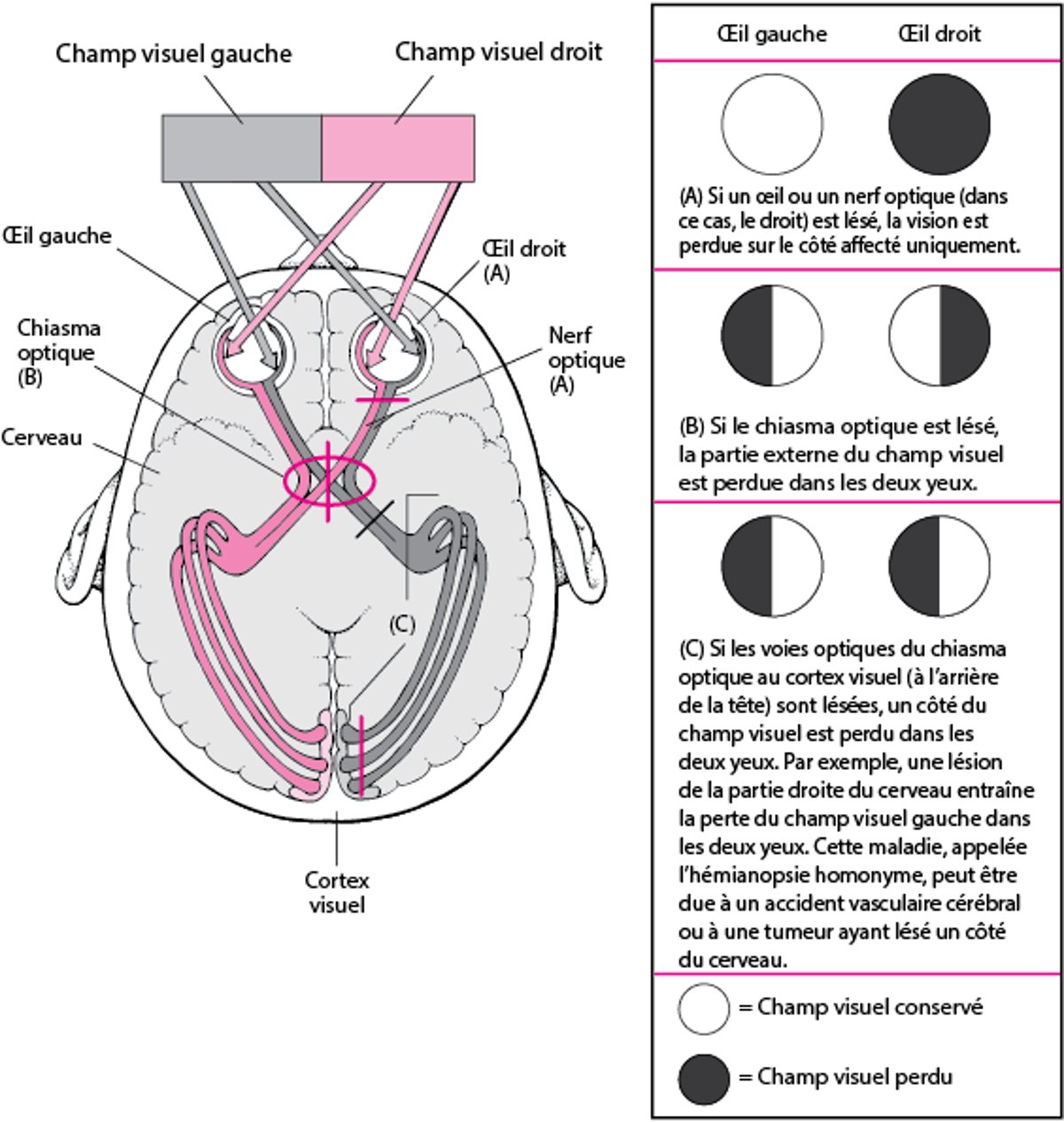 Voies visuelles et conséquences des lésions