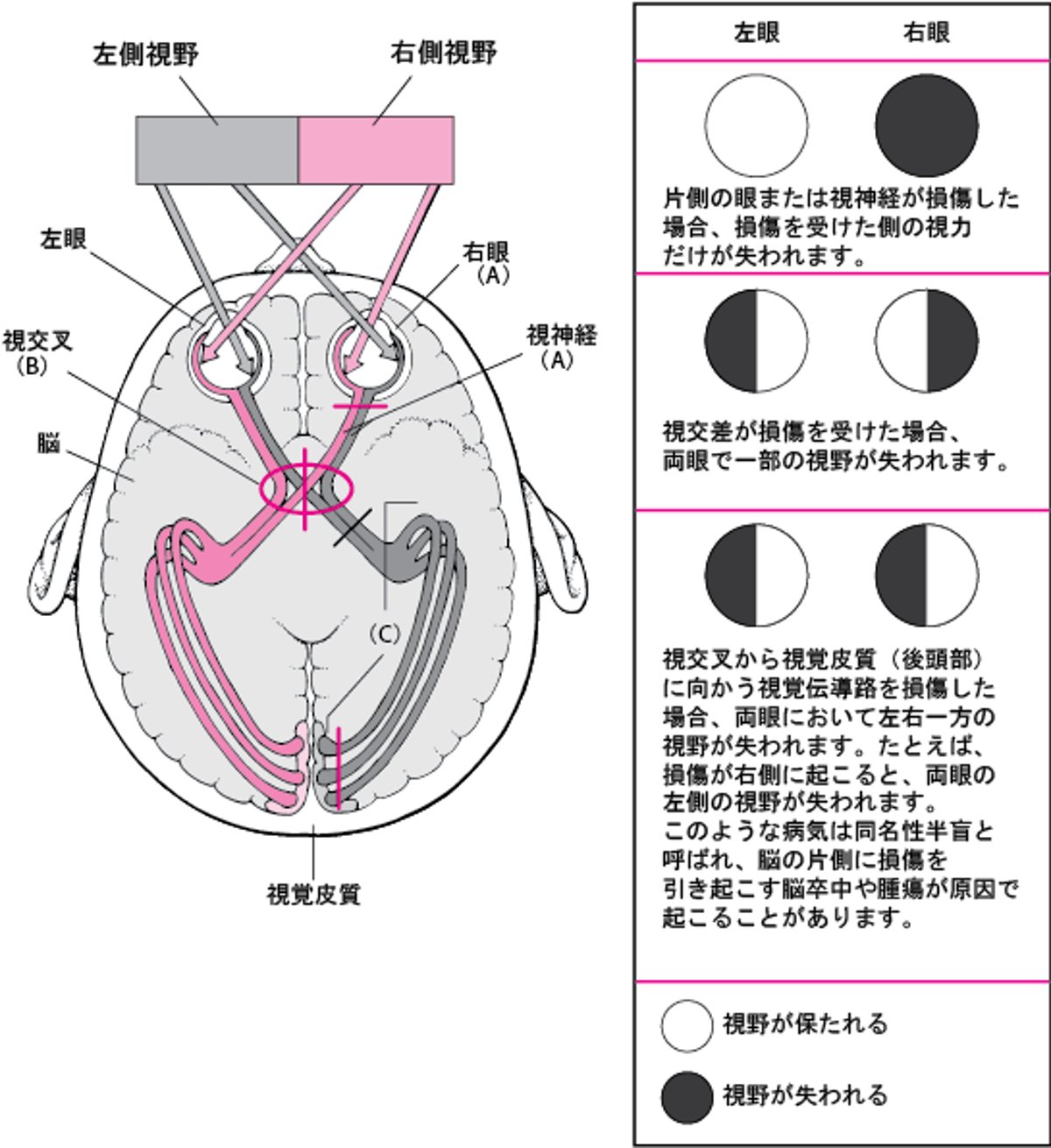 視覚路とその損傷の結果