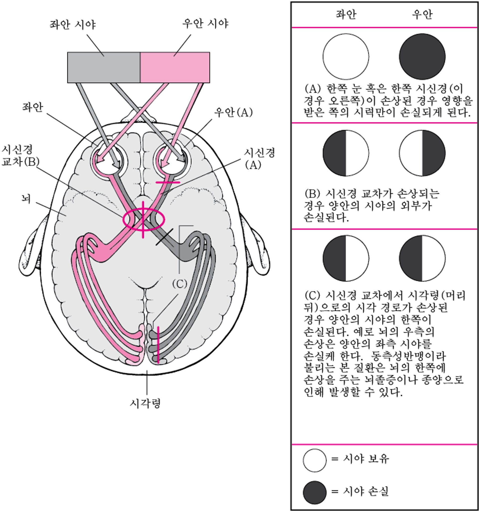 시각 경로와 손상 결과