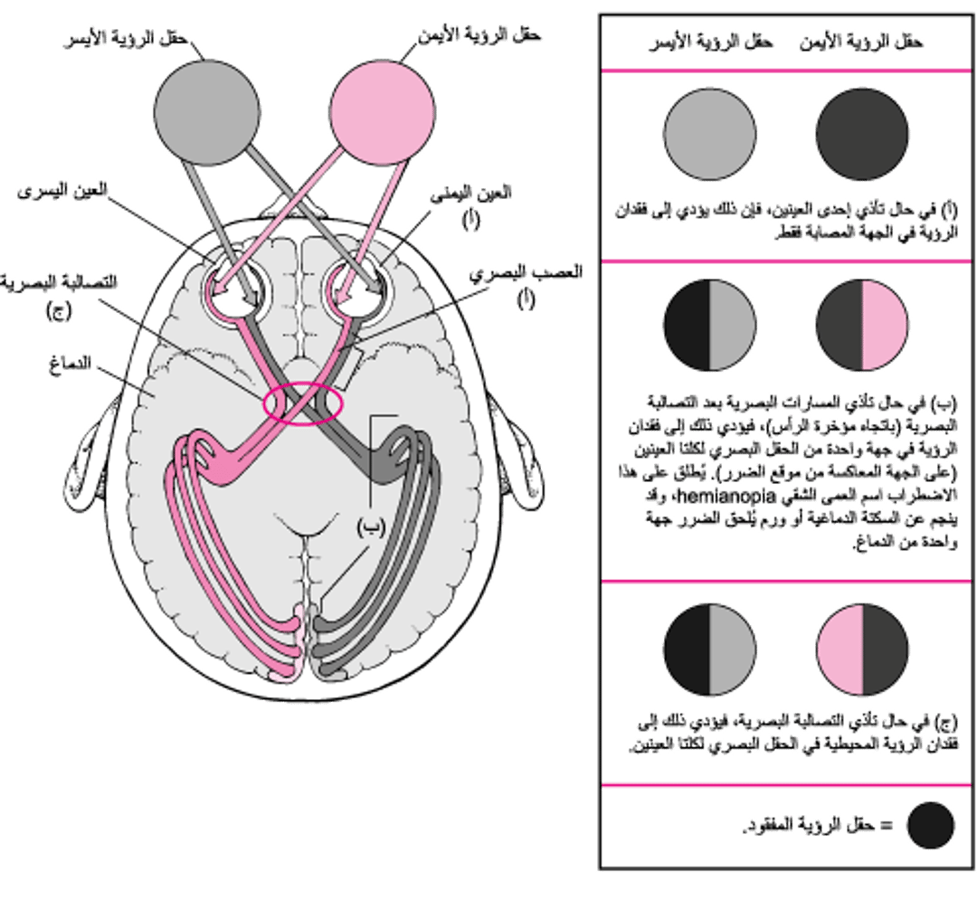 عند تضرَر المسارات البصرية
