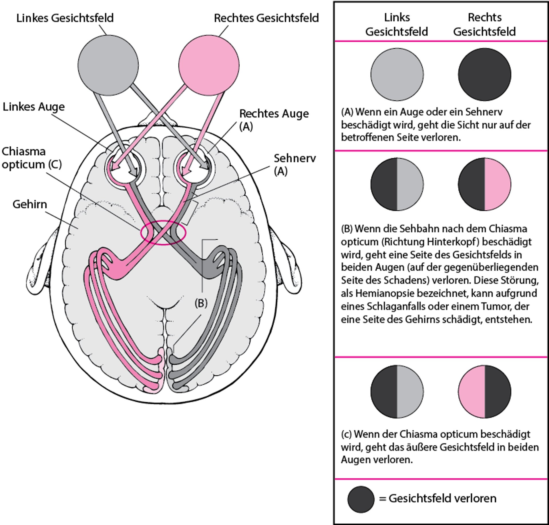 Wenn die Sehbahnen beschädigt sind