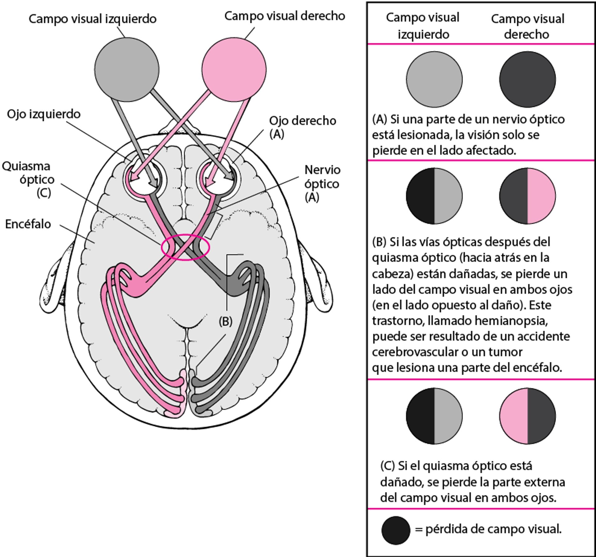 Cuando las vías ópticas están dañadas