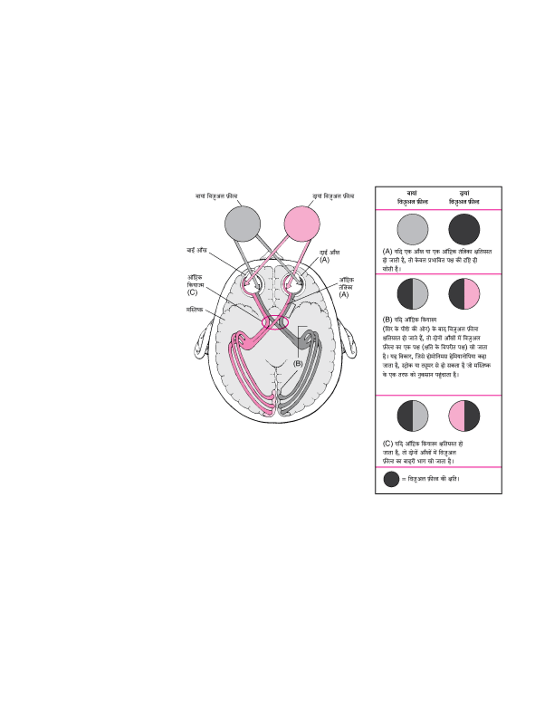जब विजुअल पाथवे क्षतिग्रस्त हो जाते हैं