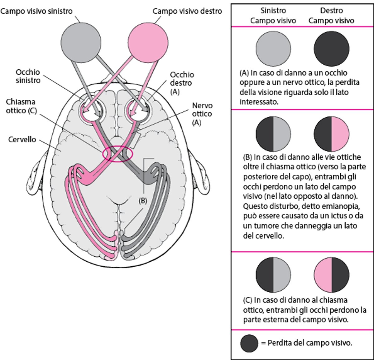 Quando le vie ottiche sono danneggiate