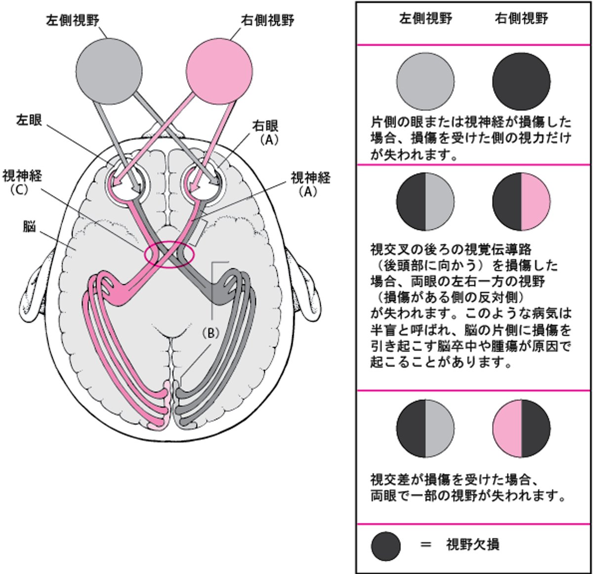 視覚路が損傷すると．．．