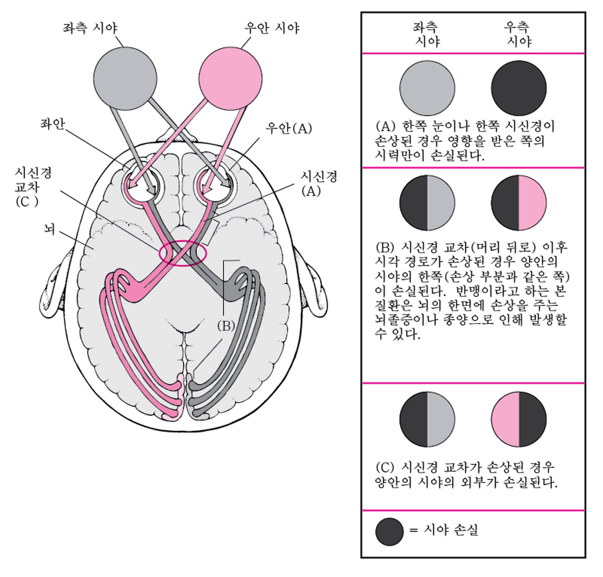 시각 통로가 언제 손상됩니까?