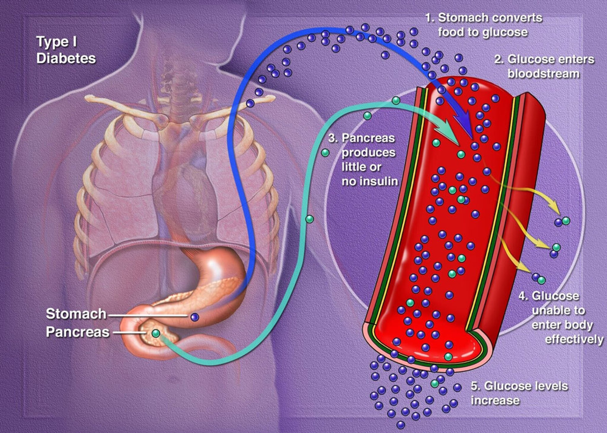 How Glucose Levels Increase in Type 1 Diabetes