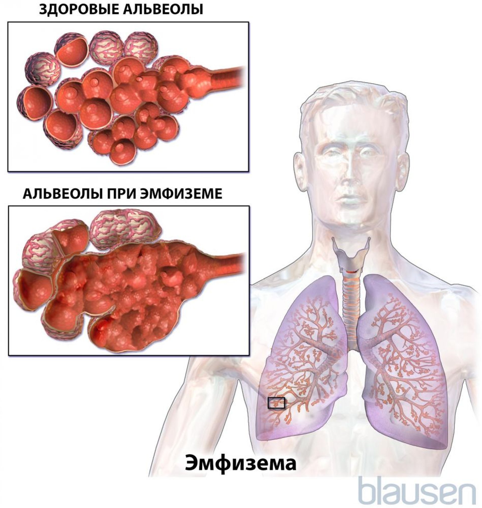 Эмфизема