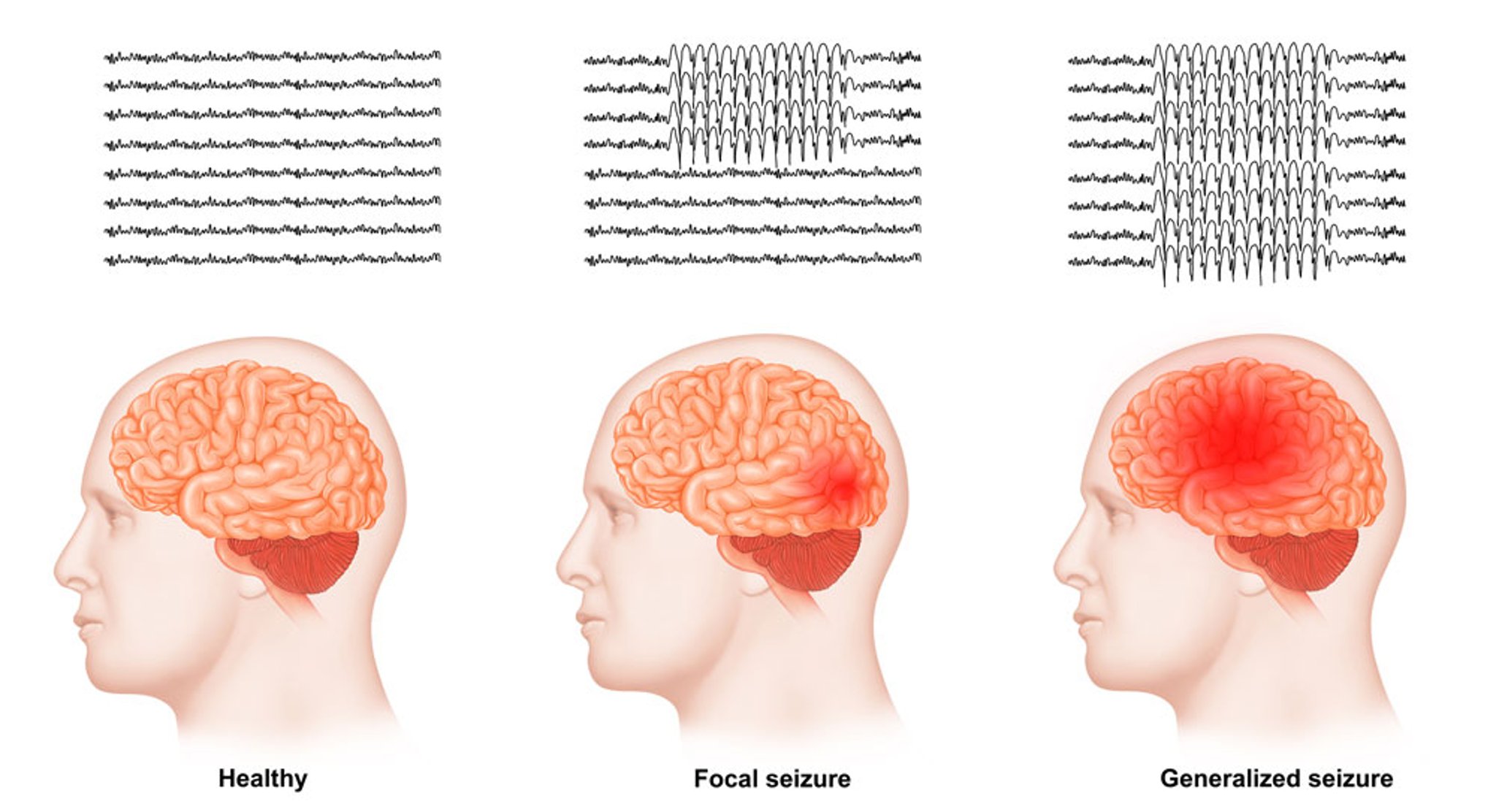 Focal and Generalized Seizures