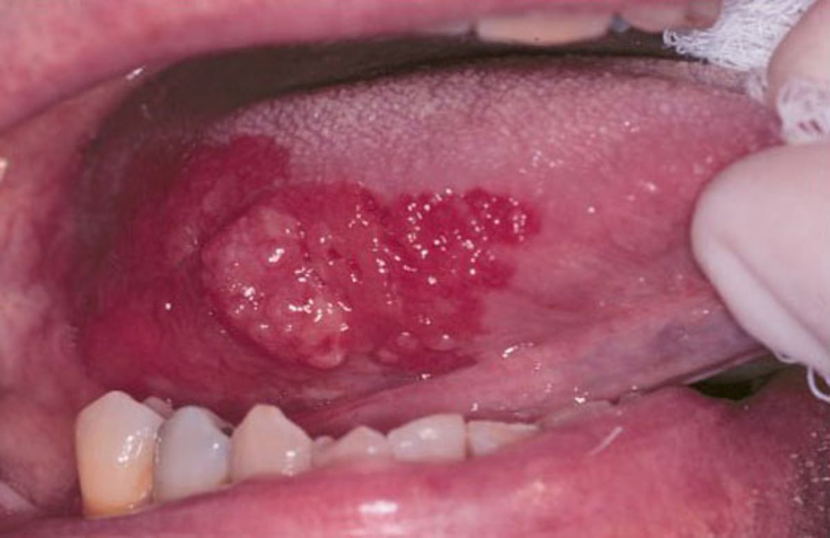 Erythroplakia and Squamous Cell Carcinoma