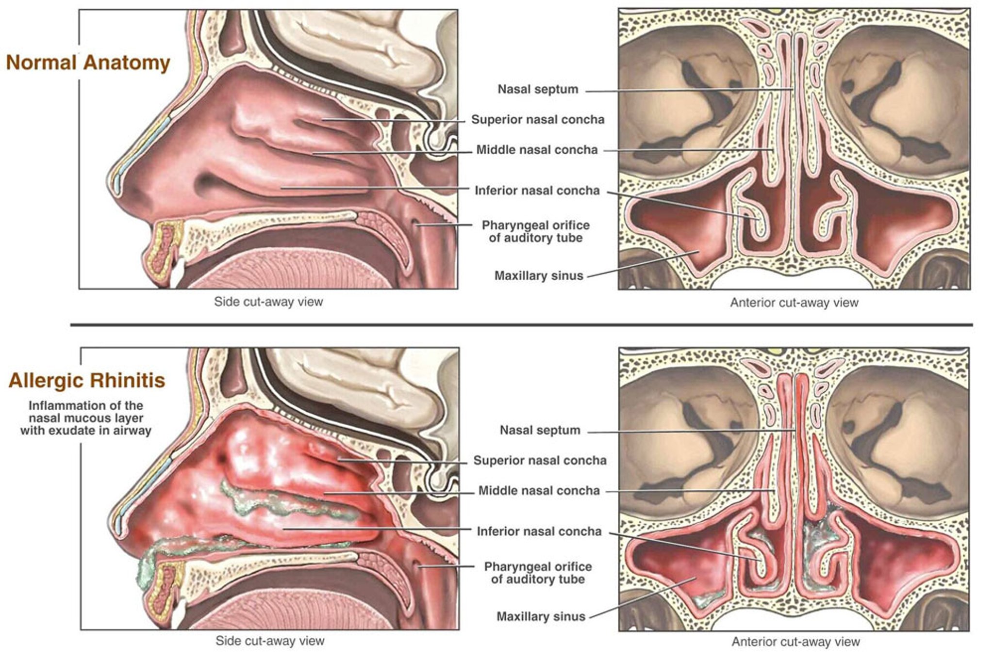 Allergic Rhinitis with Severe Swelling of the Nasal Tissues