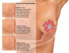 Autopalpation des seins