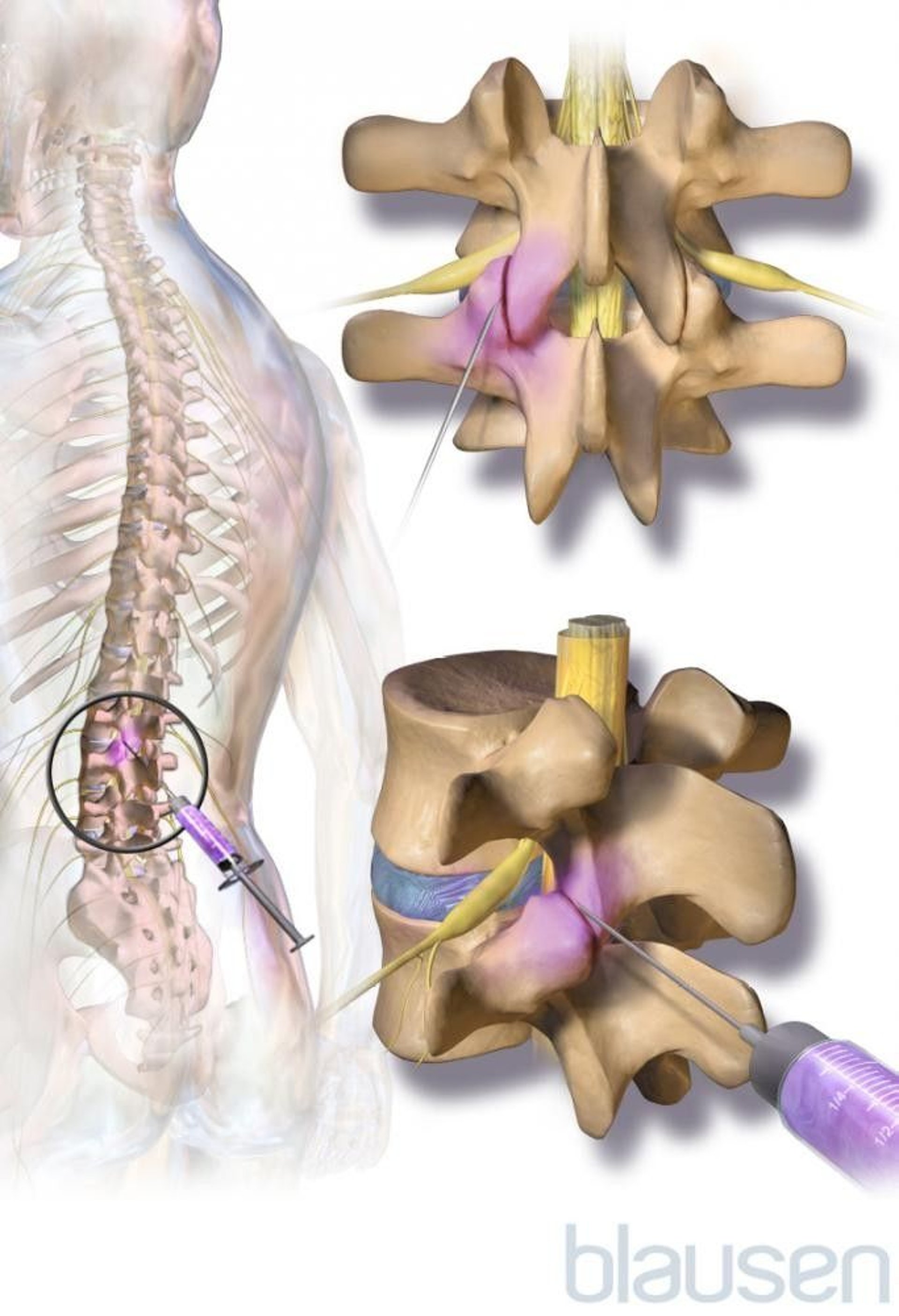 Facet Joint Injection