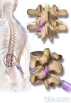 Injection dans les articulations zygapophysaires