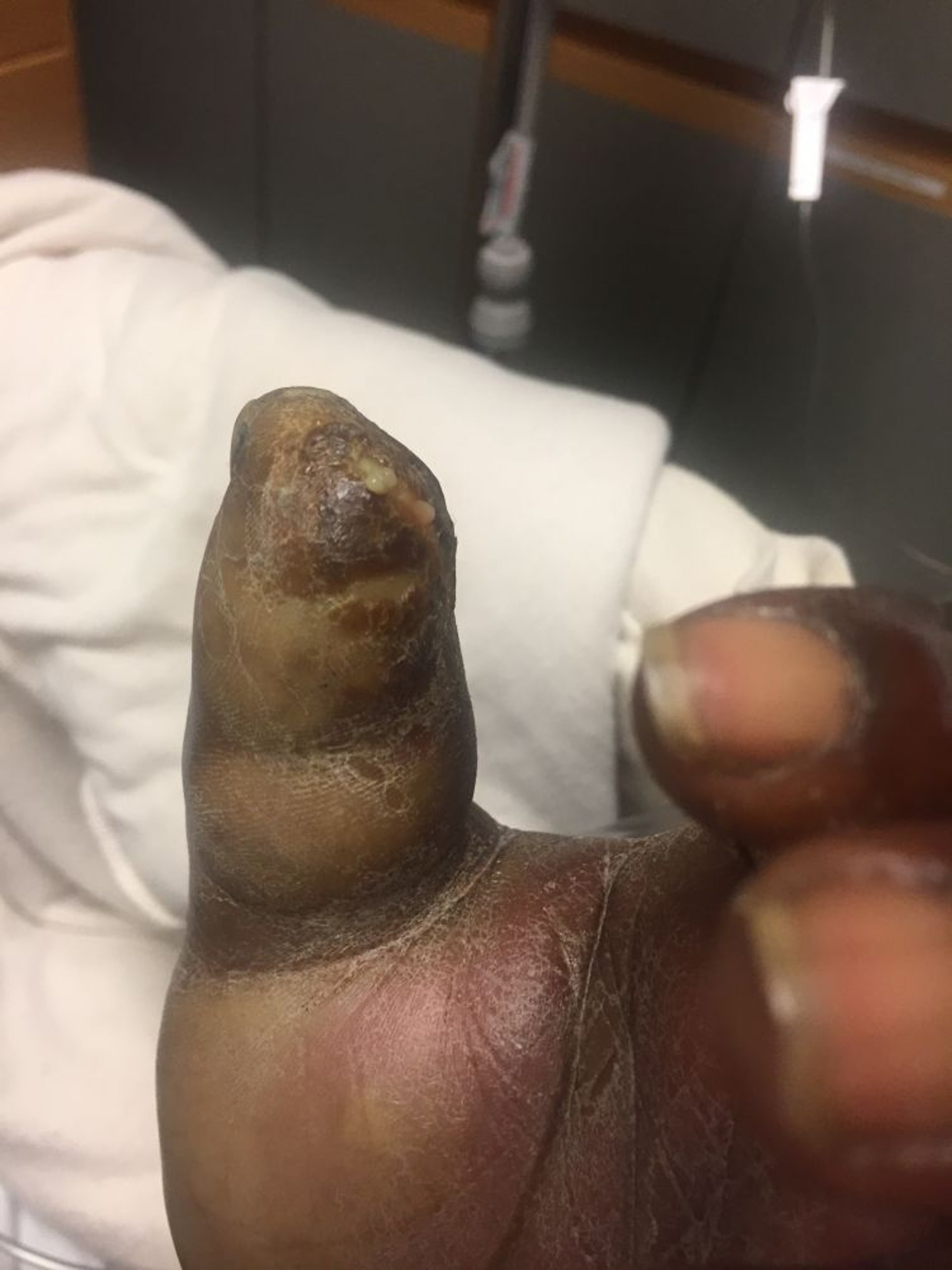 Nagelbettentzündung