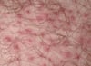 Folliculitis