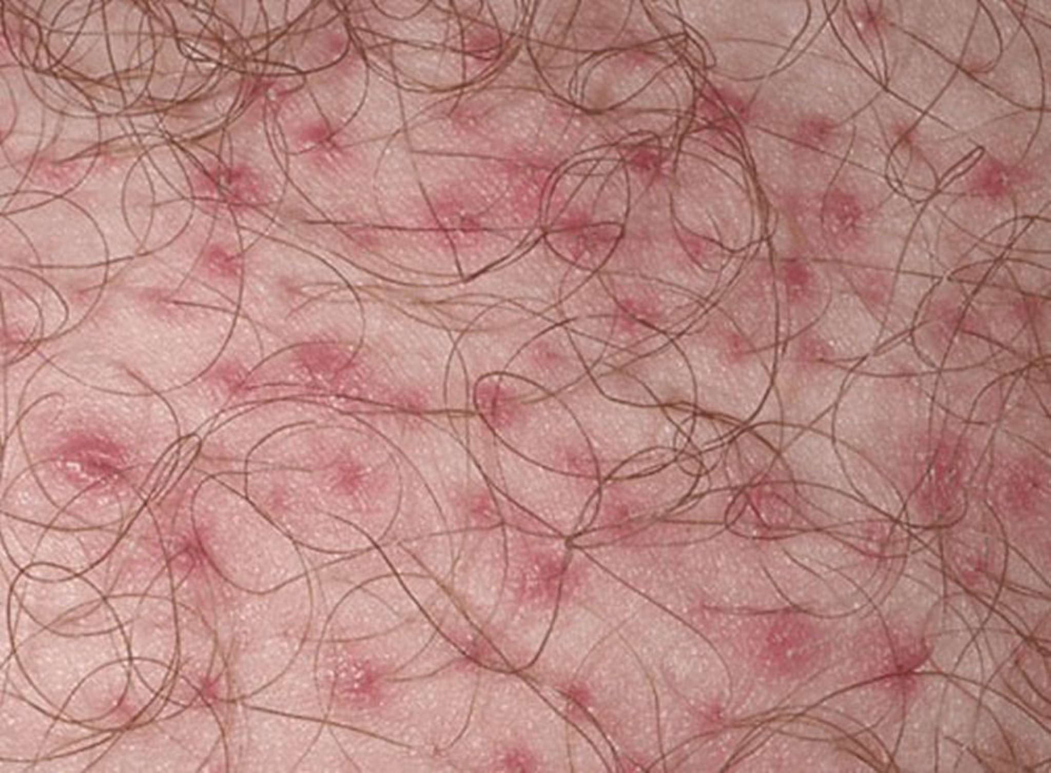 التهابُ الجريبات الشعريَّة folliculitis