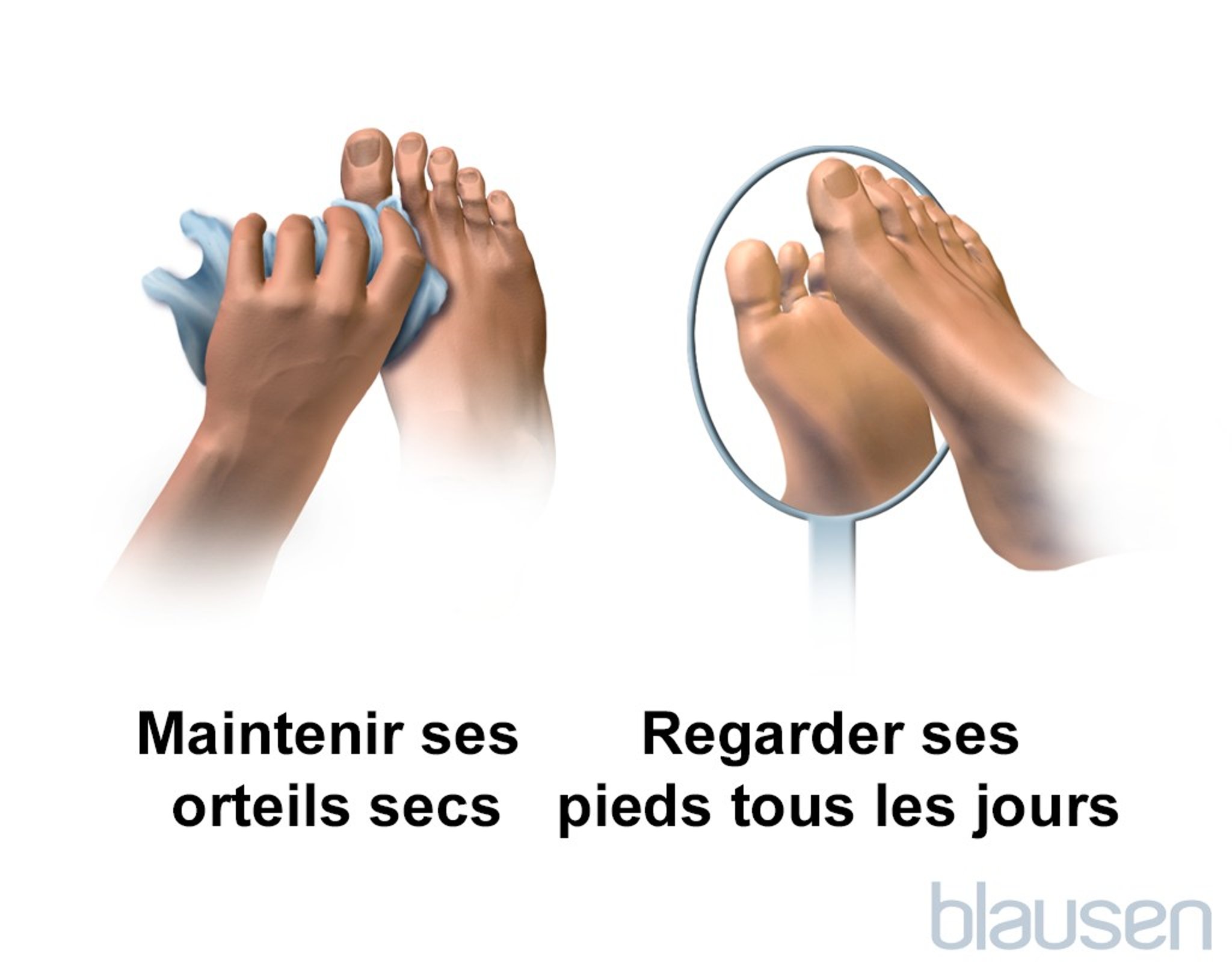 Soins des pieds chez les personnes diabétiques