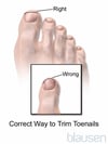 Correct Way to Trim the Toenails