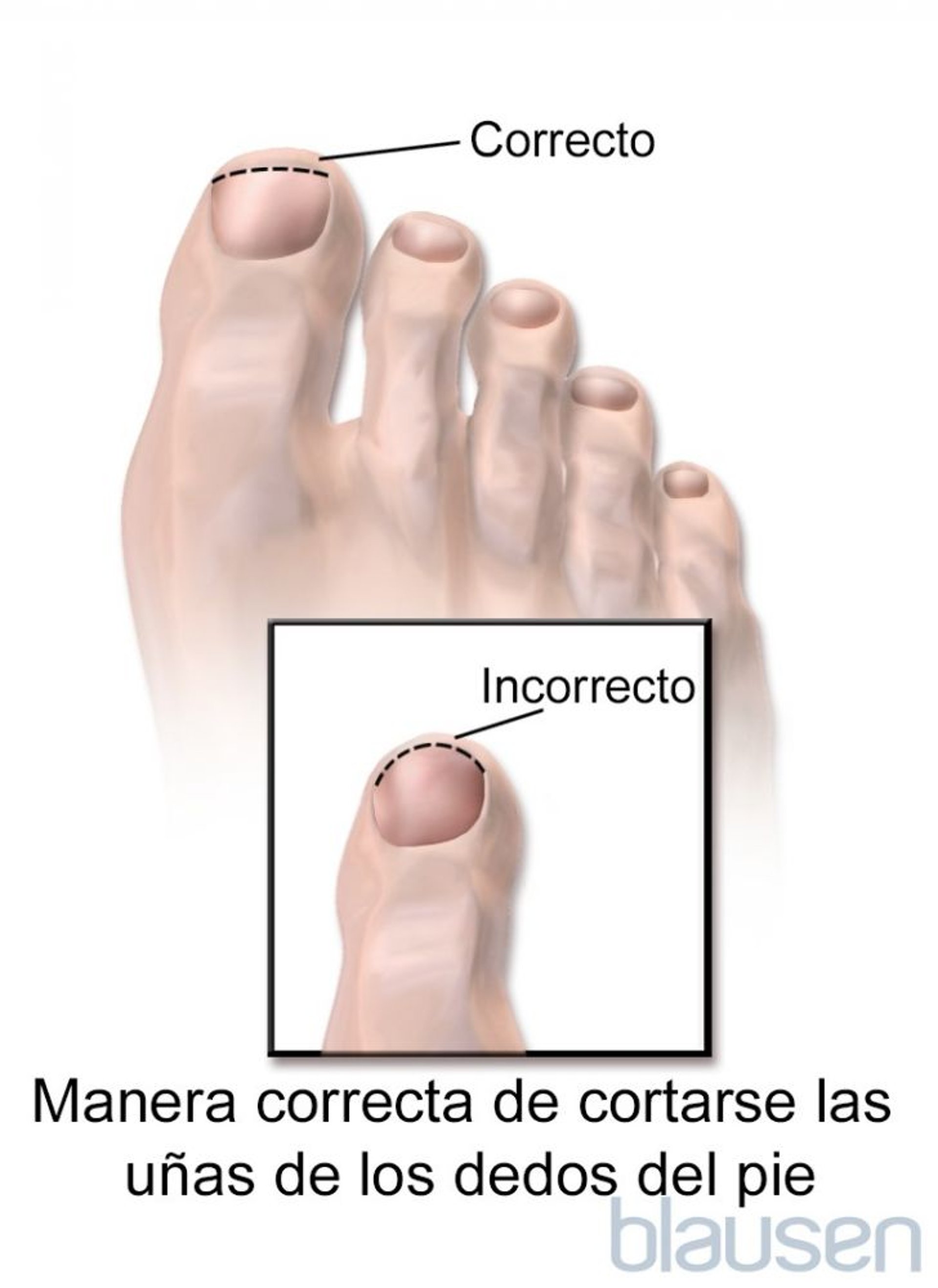 Forma correcta de recortar las uñas de los pies