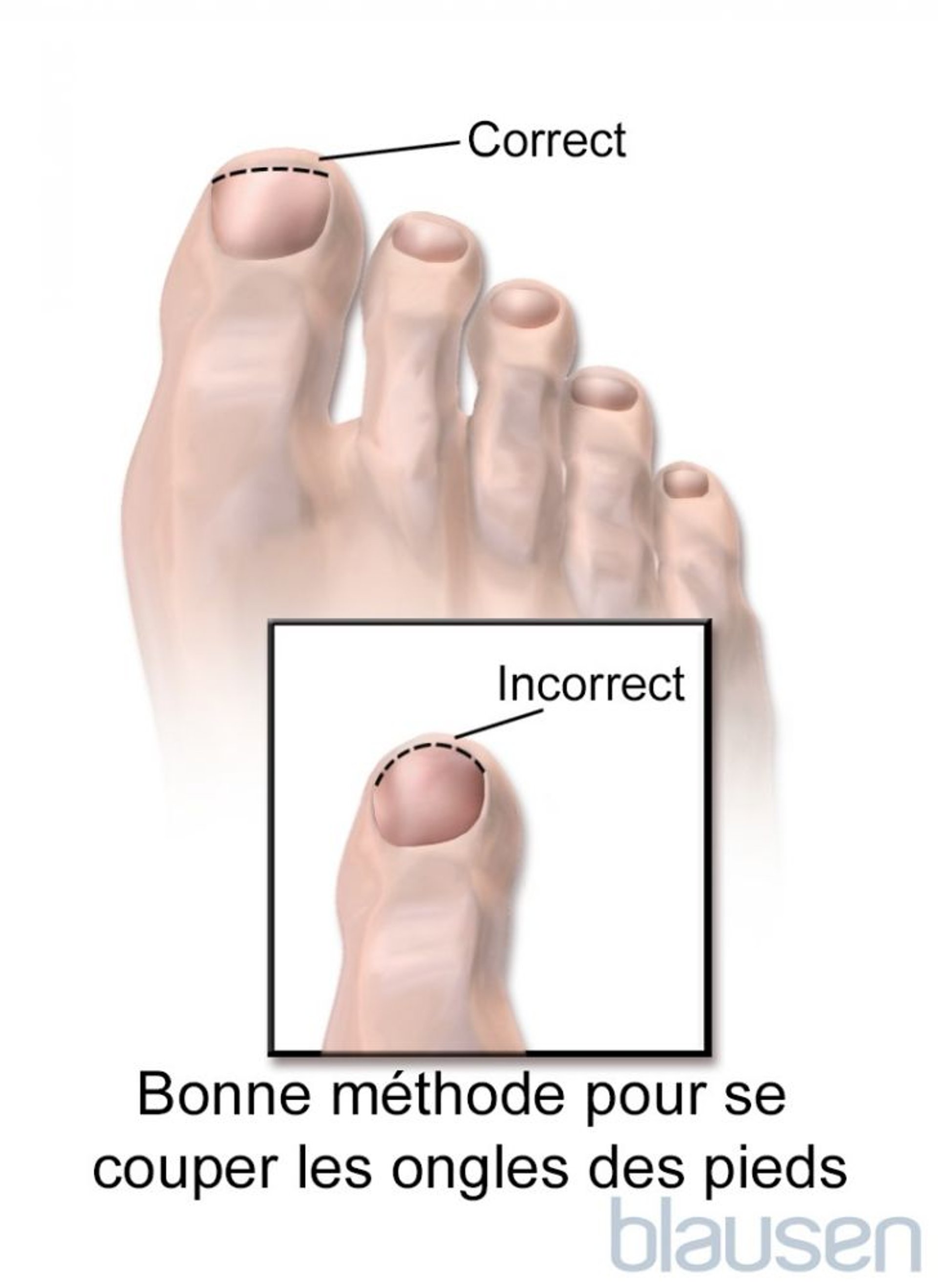 La bonne méthode pour couper les ongles des orteils
