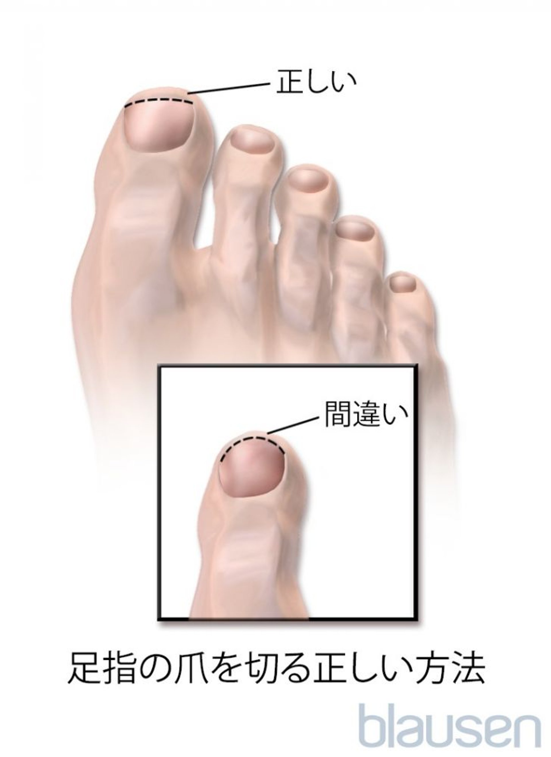 足の爪の正しい切りかた