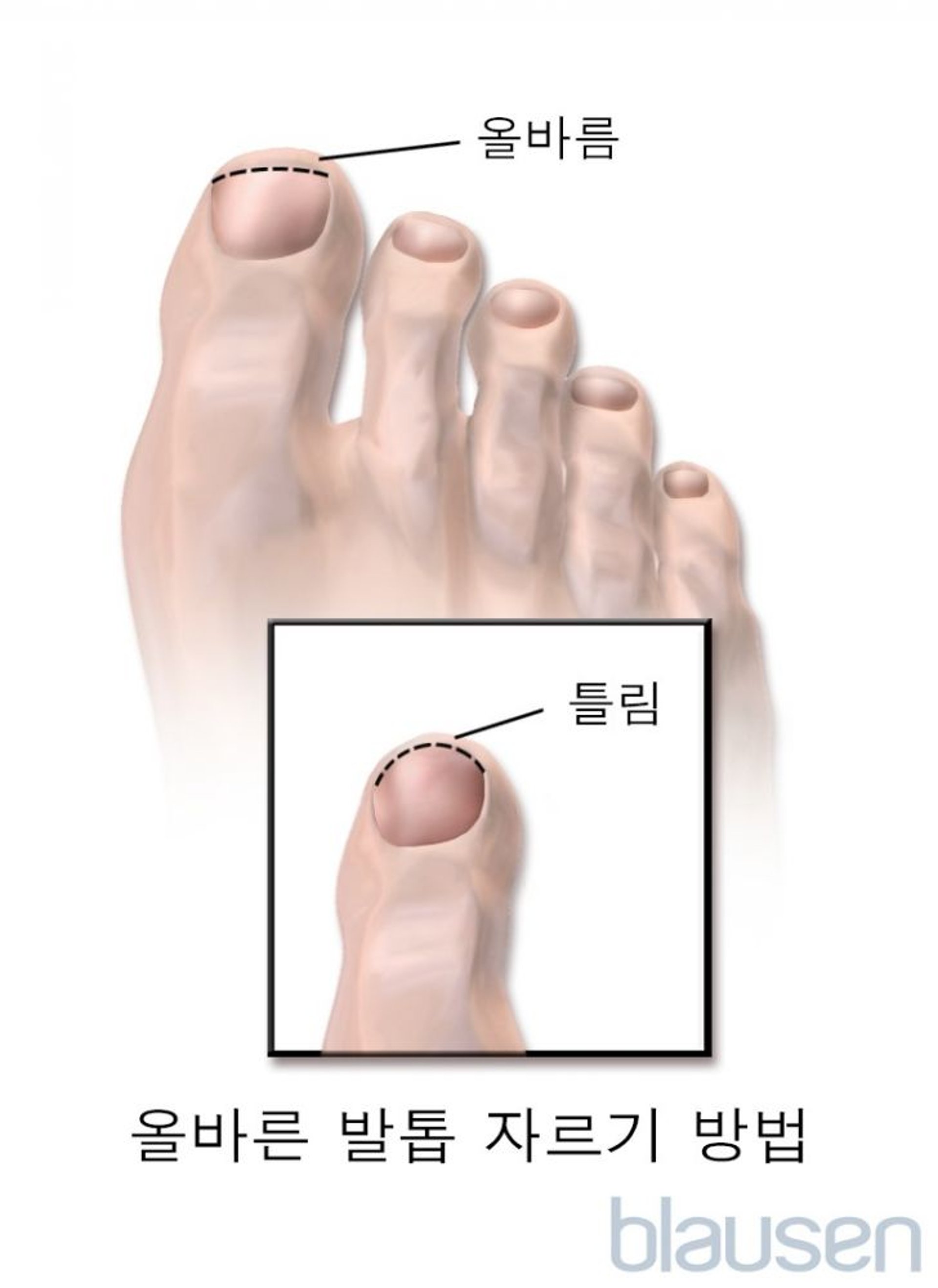 올바른 발톱 자르기 방법