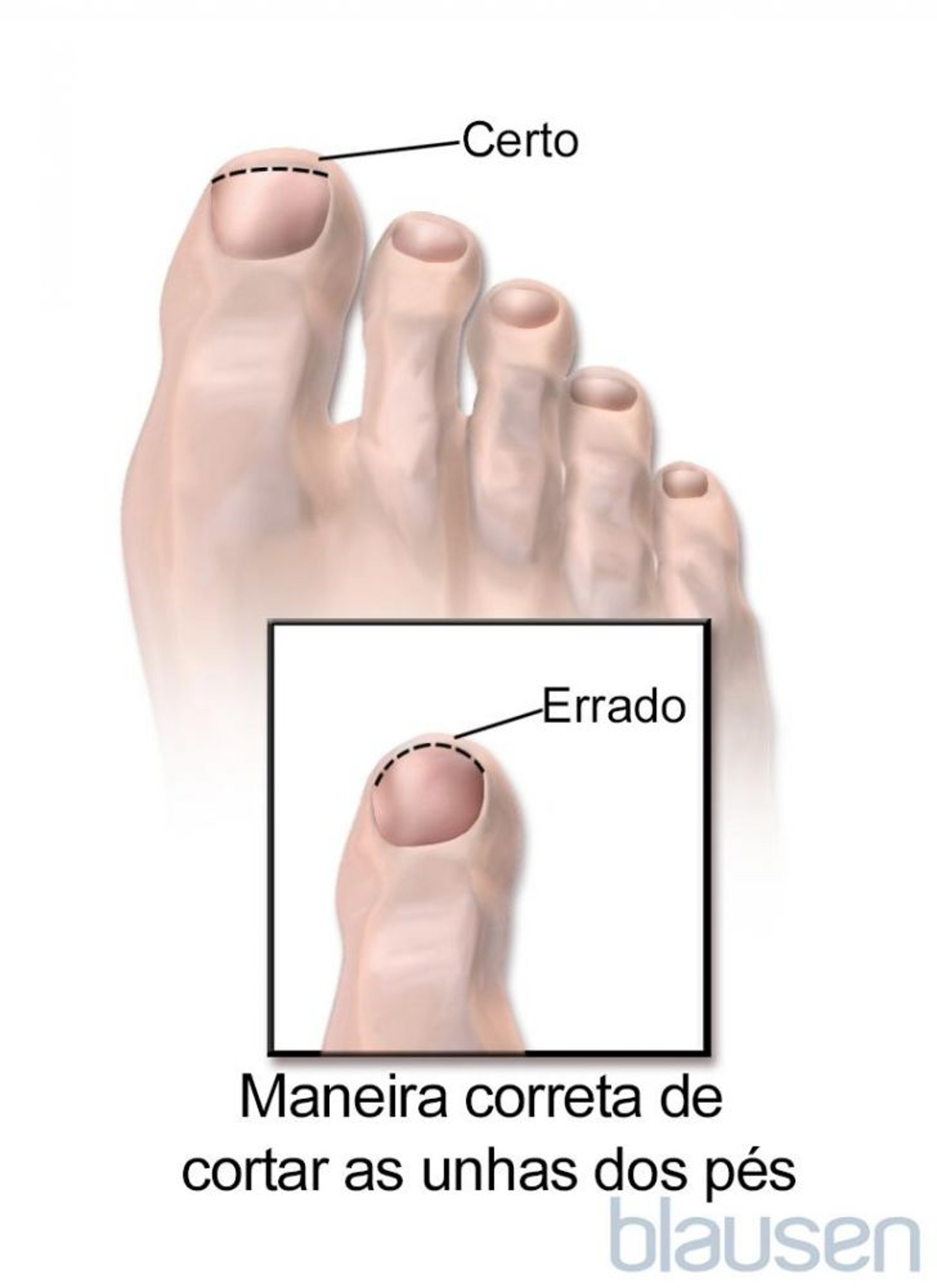 Maneira correta de cortar as unhas dos pés