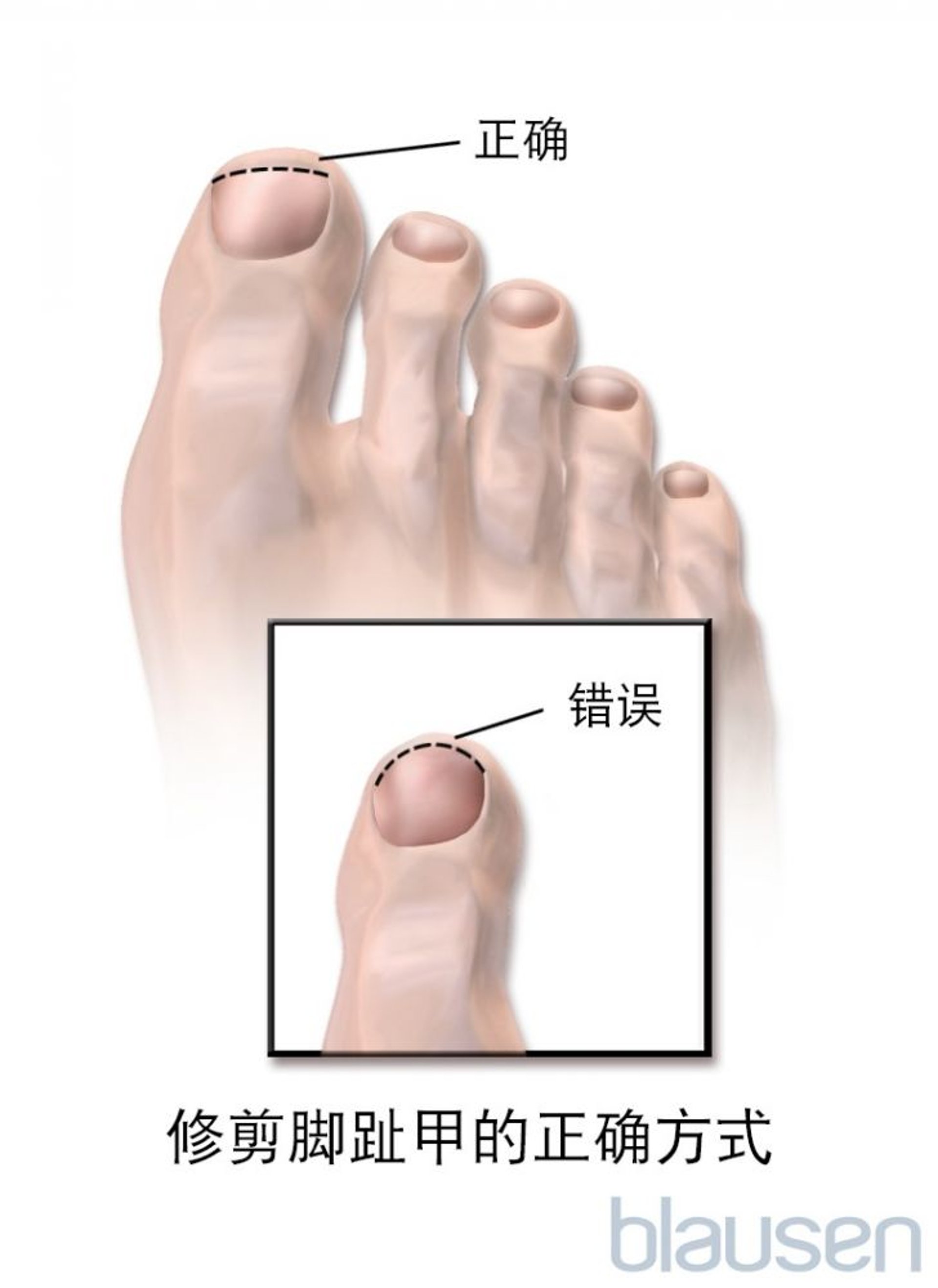 修剪趾甲的正确方式