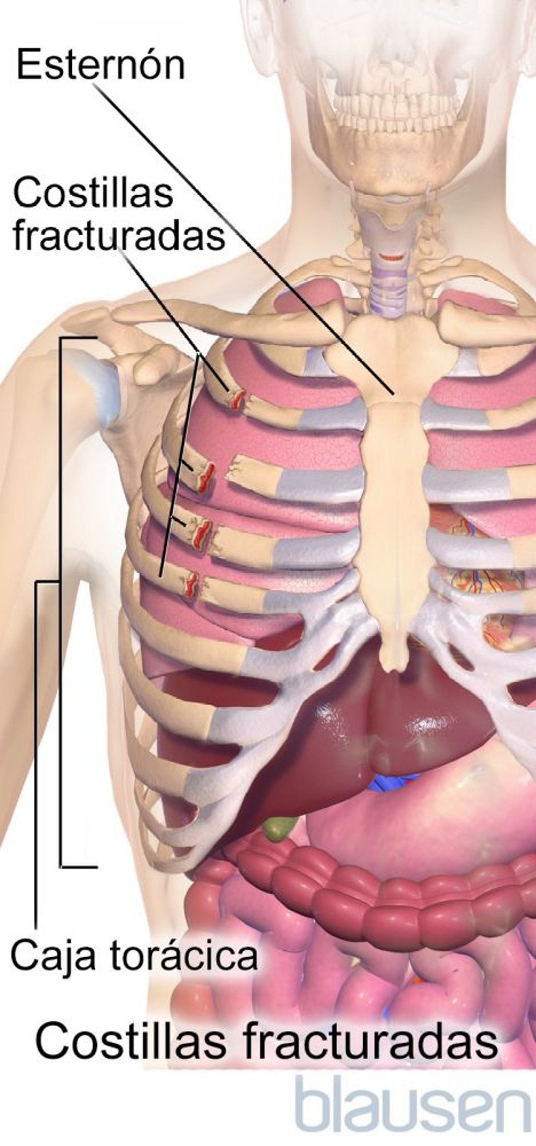 Costillas fracturadas