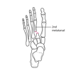 Lisfranc Fracture-Dislocation