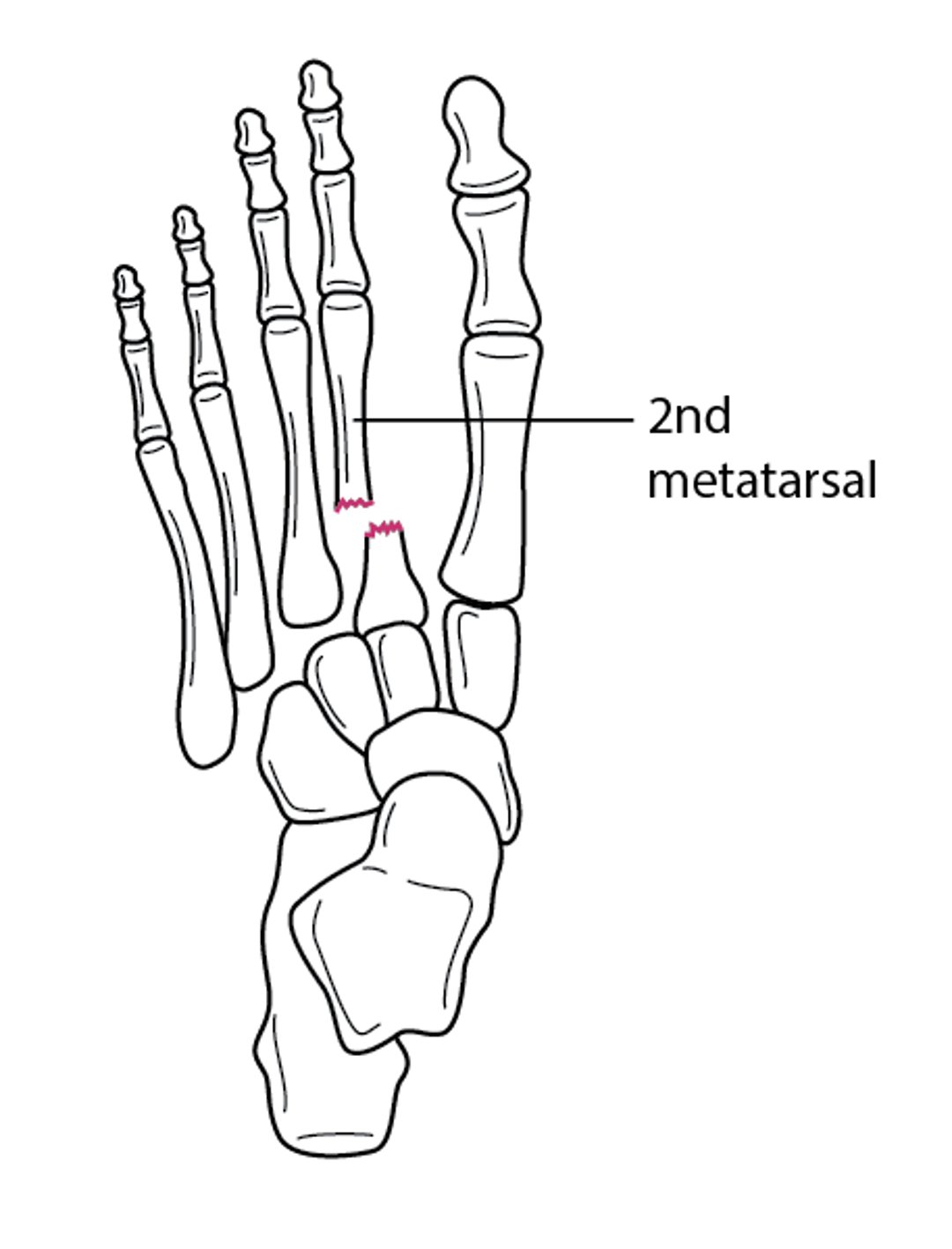 Lisfranc Fracture-Dislocation