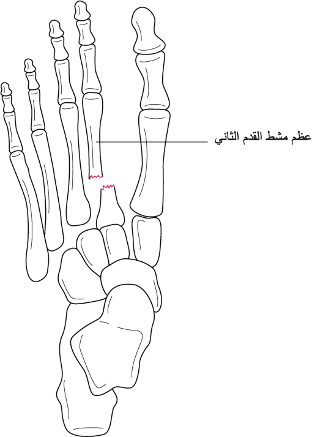 الكسرُ الخلعيّ بحسب لِيسفرانك