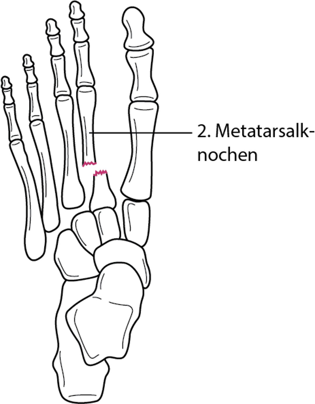 Lisfranc-Luxationsfraktur