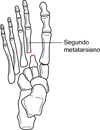 Fractura-luxación de Lisfranc