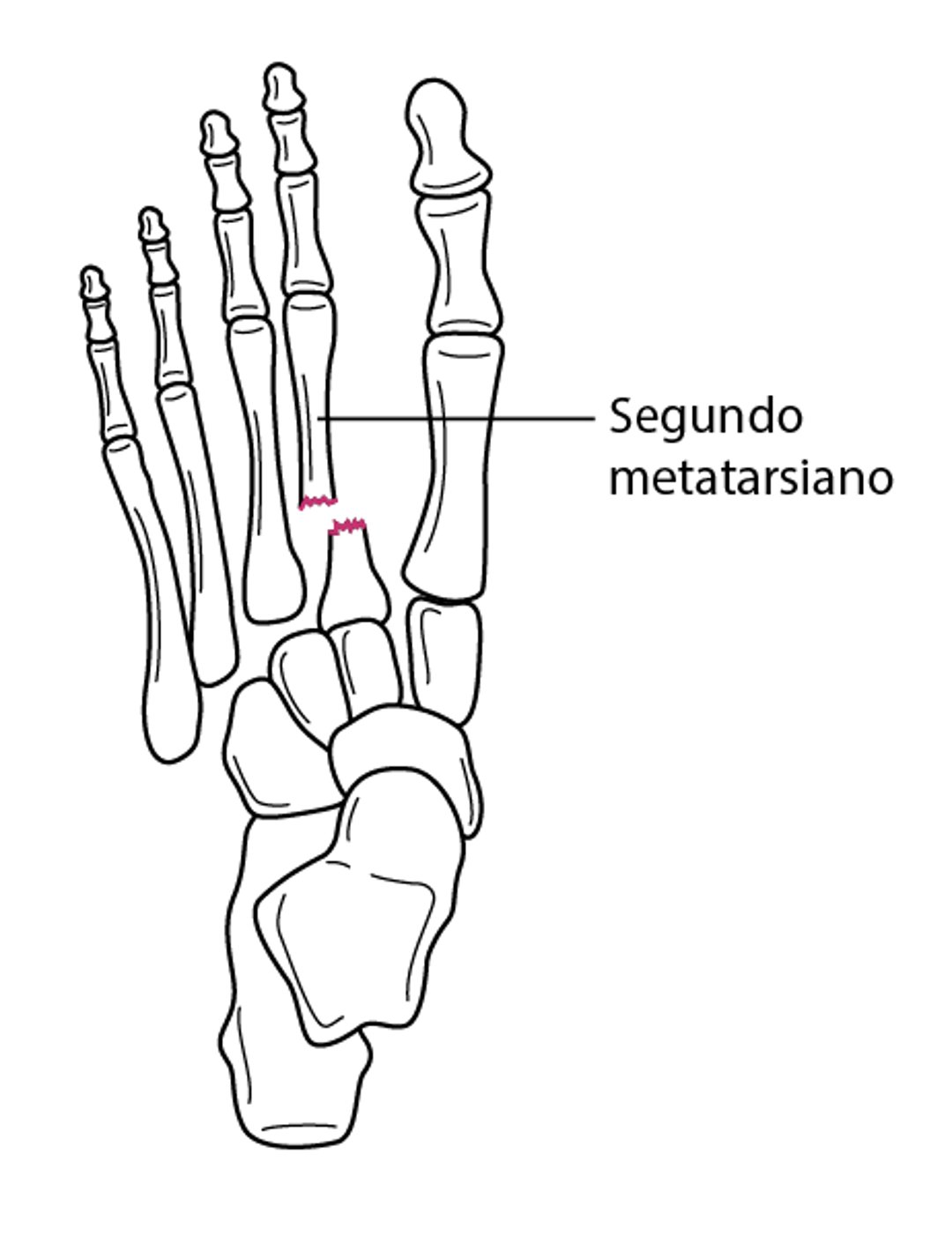 Fractura-luxación de Lisfranc