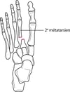 Fracture-luxation de l’articulation de Lisfranc