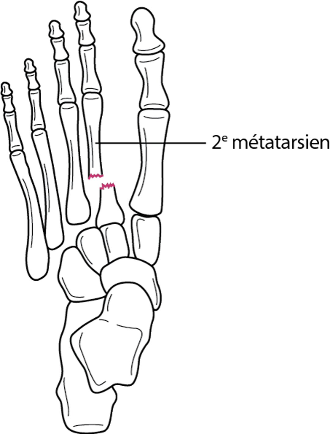 Fracture-luxation de l’articulation de Lisfranc