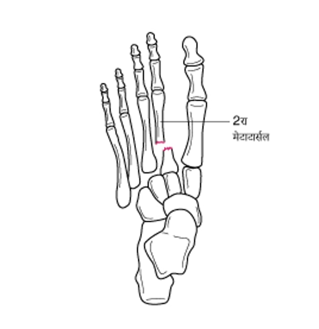 लिस्फ्रैंक फ्रैक्चर-डिस्लोकेशन