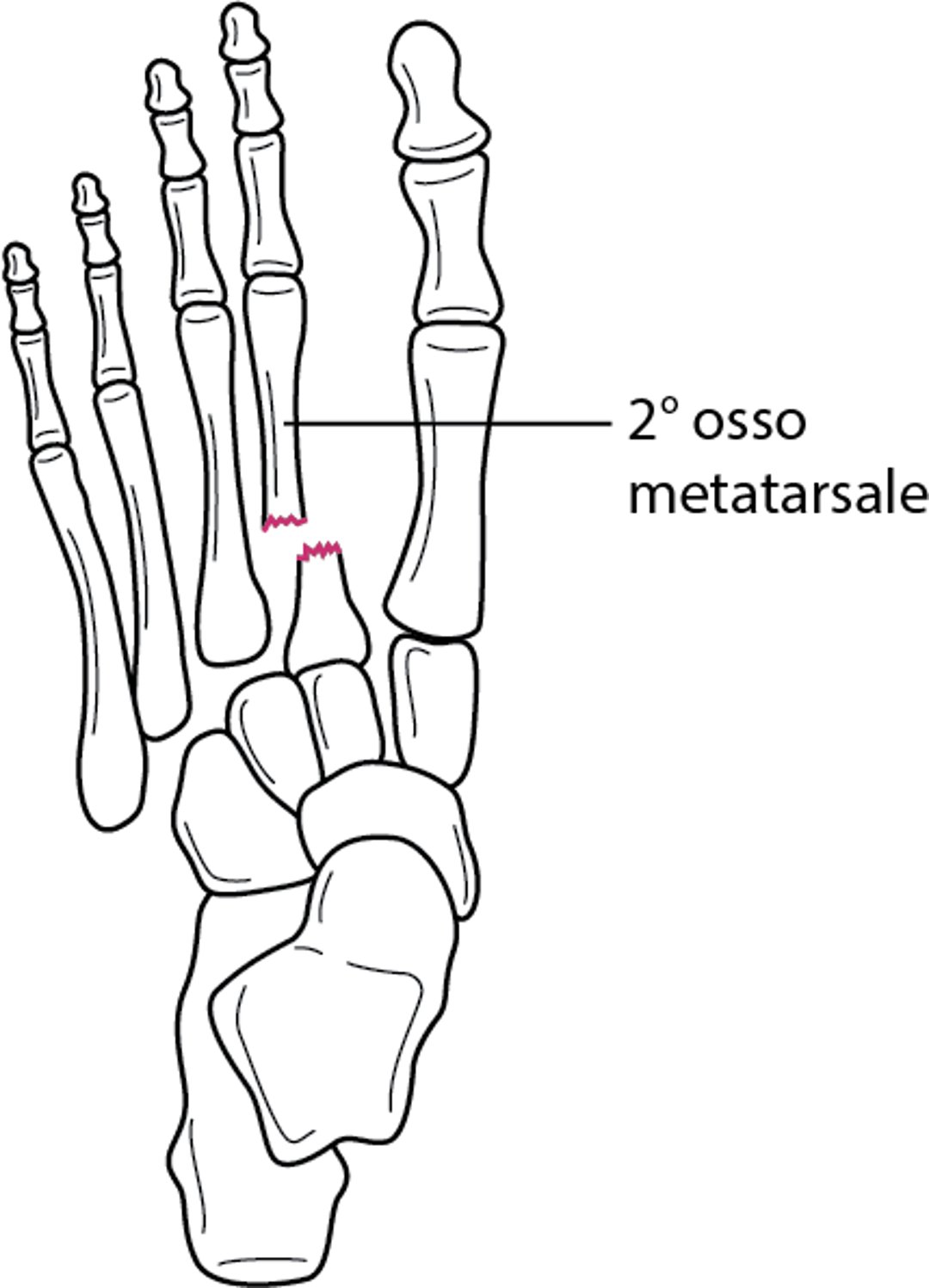 Frattura-lussazione di Lisfranc